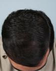 After Hair Transplant&nbsp;Front